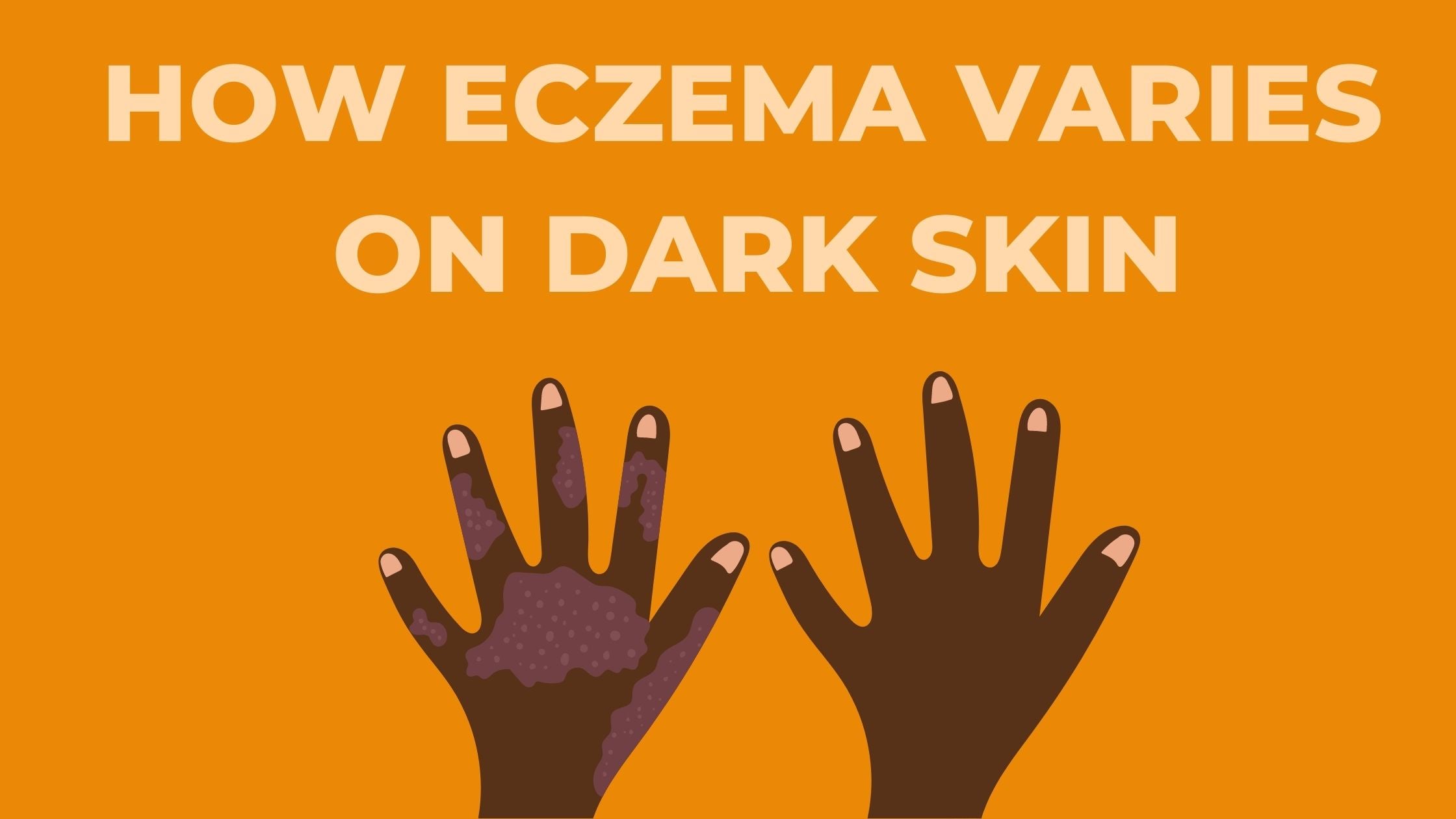 HOW ECZEMA VARIES ON DARK SKIN